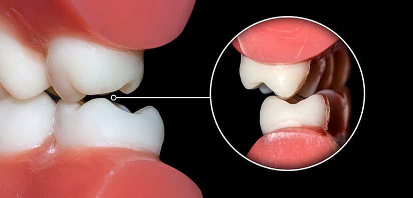 OCCLUSION REHABILITATION: Tips & Tricks